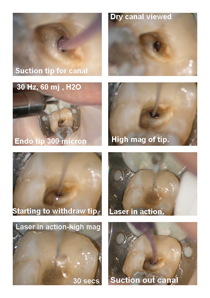 Endo on molar edited pg 2.jpg